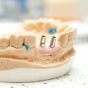 two dental implants in a model of the jaw