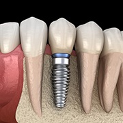 dental implant post with crown in the bottom jaw