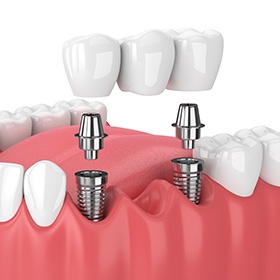 two dental implant posts supporting a dental bridge