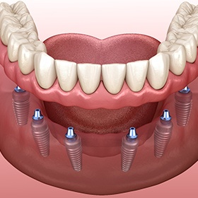Illustration of implant dentures in Goode, VA with six posts