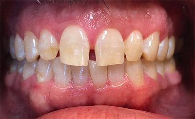Yellow smile before treatment