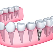 Illustration of a single dental implant in Goode, VA