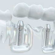 Model of a dental implant bridge in Goode, VA