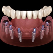Denture being attached to six dental implants in Goode, VA
